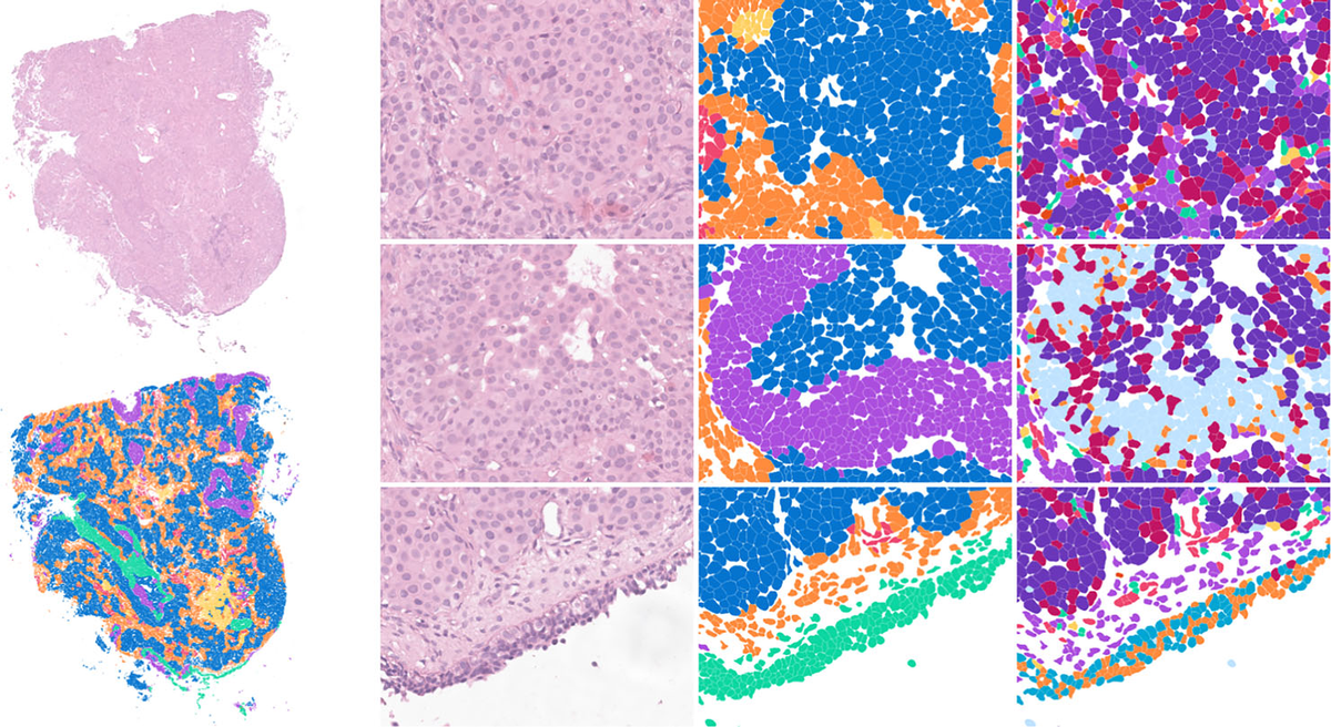 Figure 1. Mapping tumor tissue at single-cell resolution: spatial transcriptomics reveals distinct cellular neighborhoods within sinonasal carcinoma, distinguishing tumor cells from surrounding basal and stromal populations.