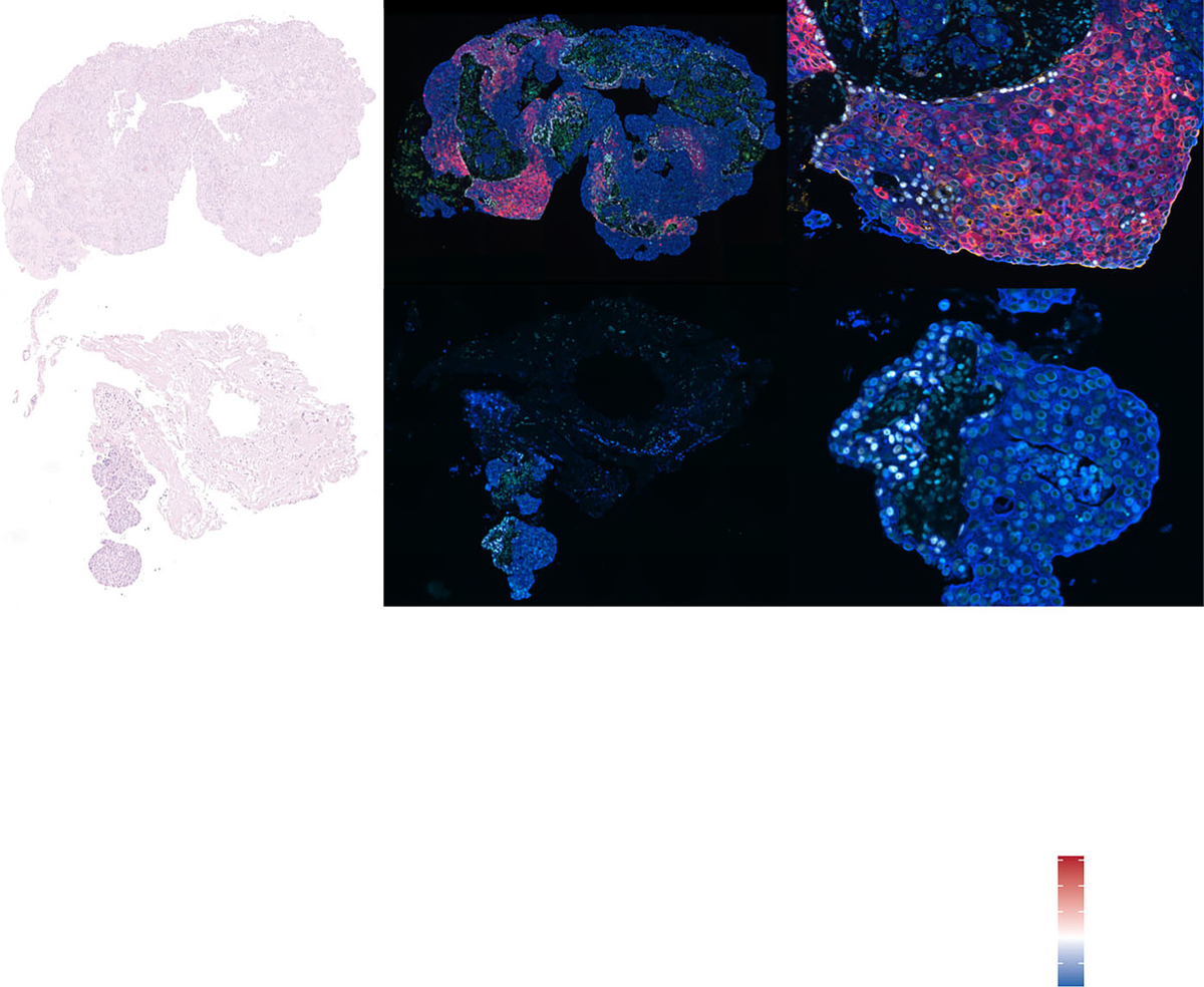 Figure 2. Fluorescent imaging highlights the tumor's cellular architecture, capturing how specialized cancer cell populations organize within the tissue.